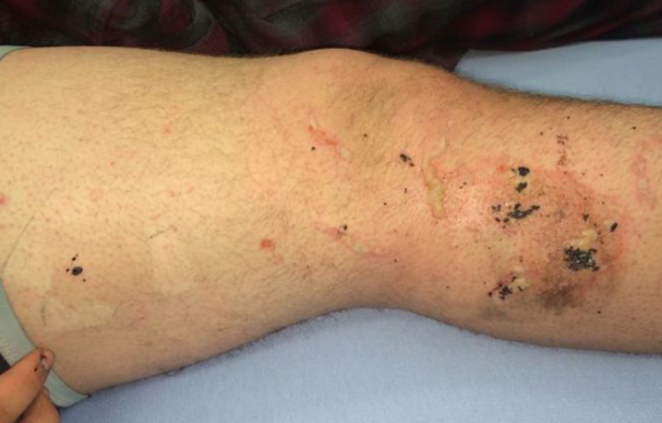 Apple-iPhone-catches-fire-burns-teenager (1)