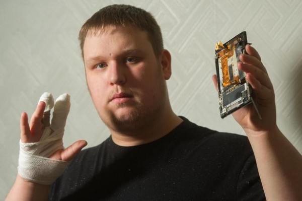 PAY-Grant-Eger-from-Malpas-was-left-with-burns-on-his-hand-after-his-Sony-Xpeira-T3-phone-exploded-as-he-was-using-it (1)